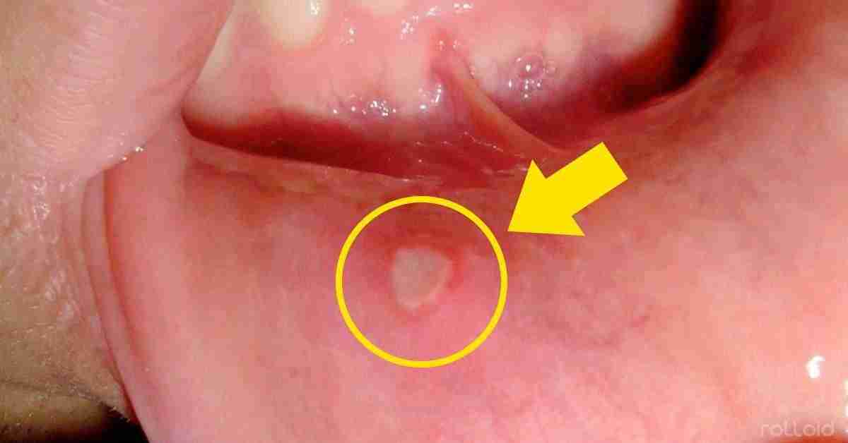 Cómo tratar las llagas con remedios naturales