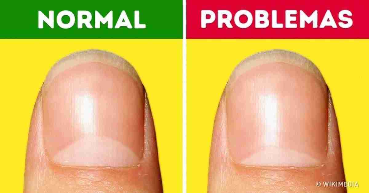 13 Problemas de salud de los que te advierten las lúnulas de tus uñas