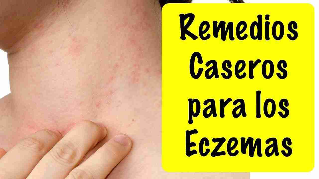 Remedios Caseros Para La Dermatitis, Psoriasis O Ezcema