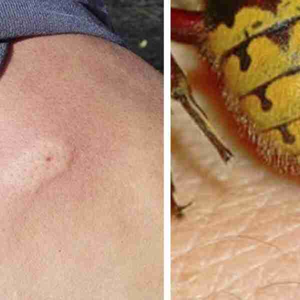 8 Cosas que debes hacer rápidamente si te pica una abeja o avispa y 3 errores a evitar