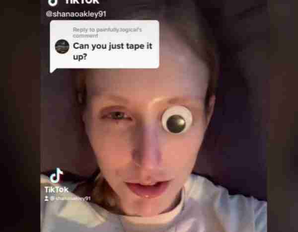 ¡Cuidado! Una tiktoker acabó ciega de un ojo por culpa del bótox