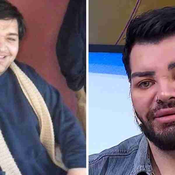Joven perdió 92 kilos y se hizo 30 cirugías para ser como Ricky Martin: “Quedé más lindo que él”