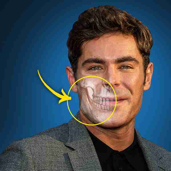 Zac Efron dice que “casi muere” y explica qué le pasó a su cara